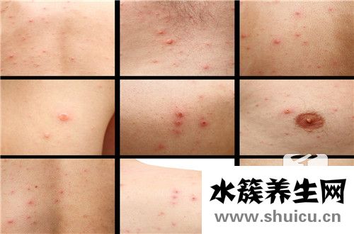 濕疹注意事項