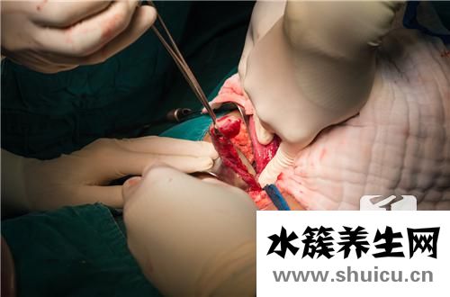 輸精管結扎術