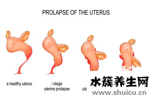 宮頸腺囊腫