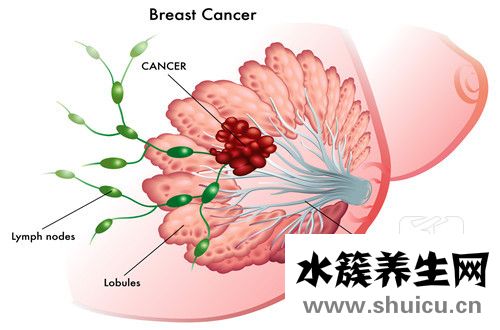乳腺導管癌