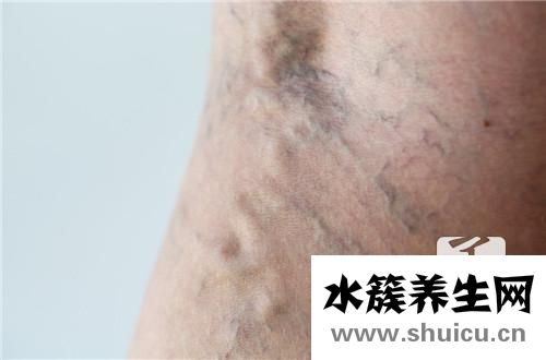 動脈硬化怎么治療