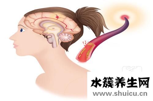 急性腦梗塞