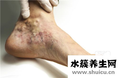 靜脈曲張預防