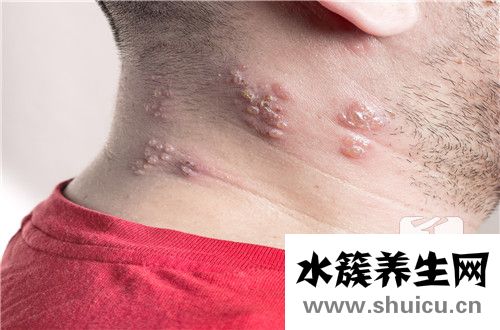 胸前長痘