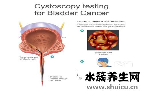 輸尿管梗阻