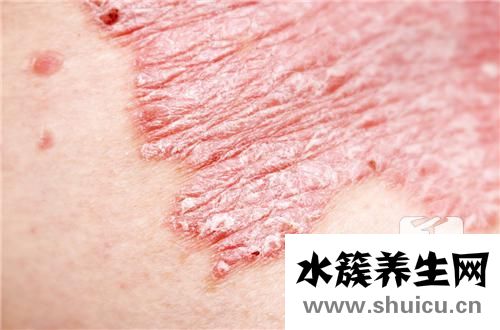 角化型手癬