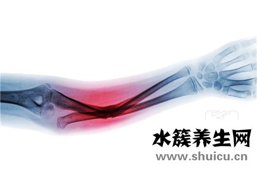 肘管綜合征