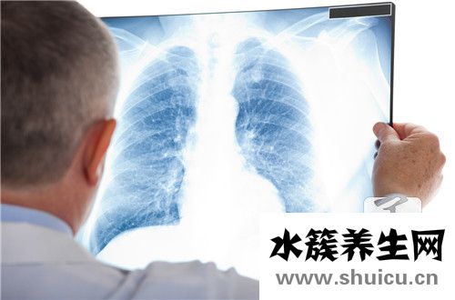浸潤型肺結核