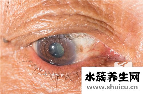眼白有黑點