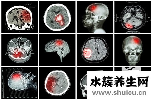 腦室引流管