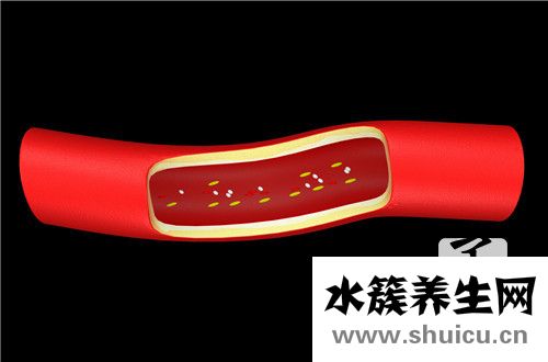 主動脈鈣化
