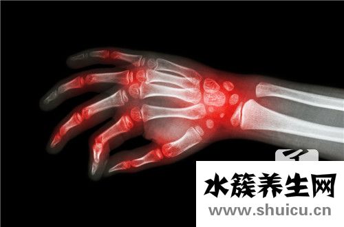 痛風消腫止痛最快方法