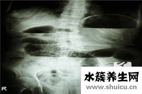 做完胃鏡后注意事項