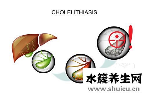 膽結石有什么癥狀