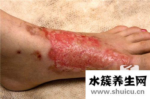 一度燙傷