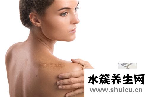 凸起性疤痕