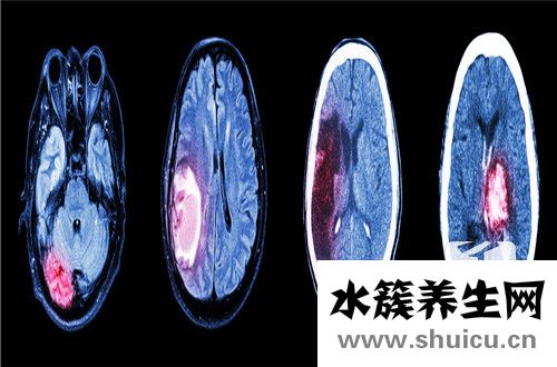 腦動脈血管瘤