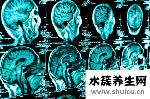 腦動脈血管瘤