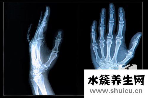 橈骨遠端骨折