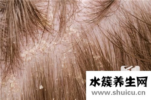 去頭屑小妙招