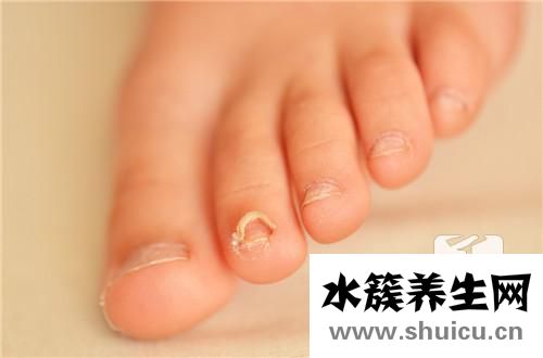 甲溝炎如何消腫
