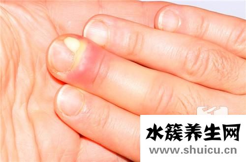 下肢水腫