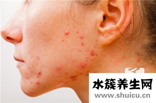 火針治療痤瘡