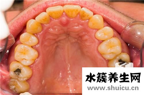 補牙痛嗎