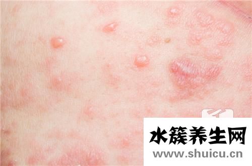 蕁麻疹是否會傳染