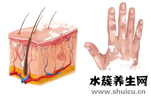 白殿瘋病