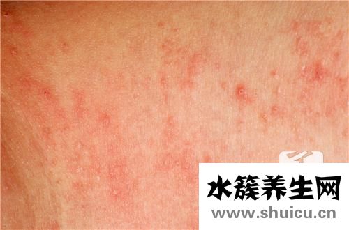 痤瘡怎樣治療