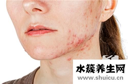 臉頰長痘痘