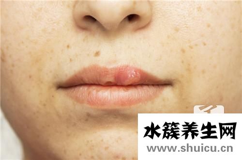 怎樣去除黑斑