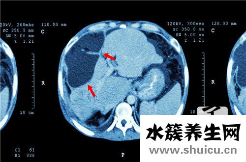 乙肝表面抗原弱陽性