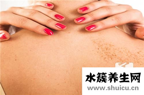 黑痣發癢