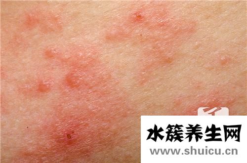 丘疹性蕁麻疹的治療