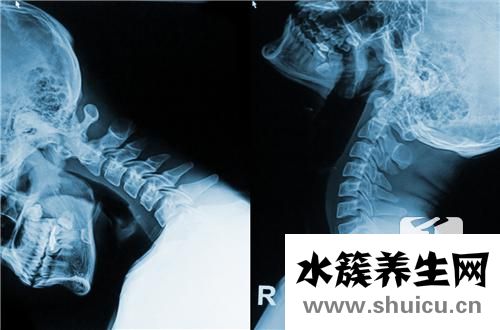 脊髓型頸椎病的癥狀