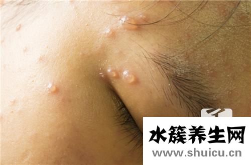 出水痘能吃什么