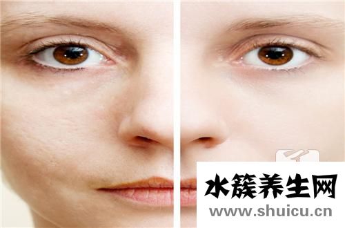 汗斑傳染嗎