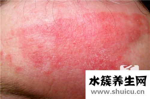 過敏性蕁麻疹癥狀