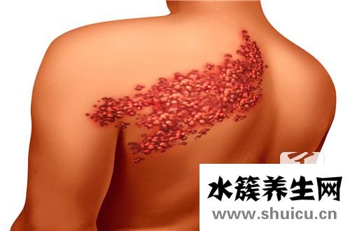 帶狀皰疹偏方