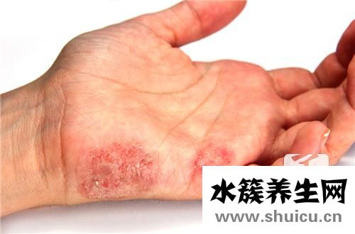 水泡型濕疹怎么治療