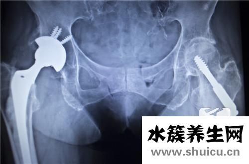 骨折恢復