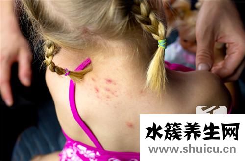 濕疹是什么癥狀