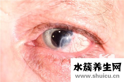 神經麻痹