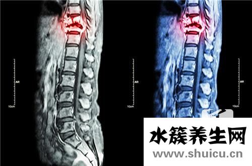 脊椎裂