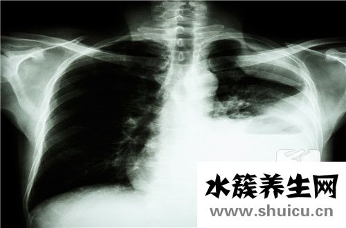 低分化鱗癌