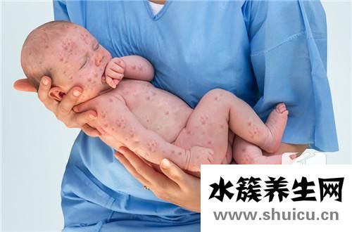 風疹是什么