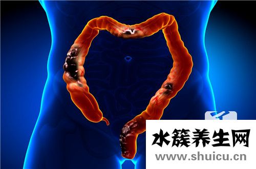 結腸腺癌