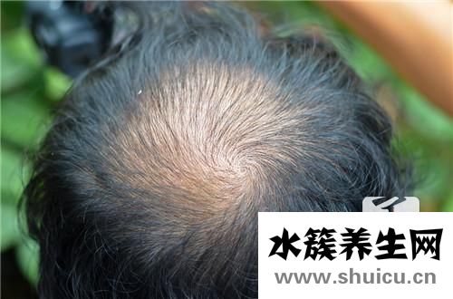 頭頂頭發稀少